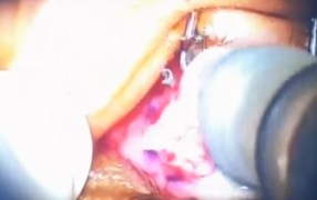 10 Minute Pterygium Technique