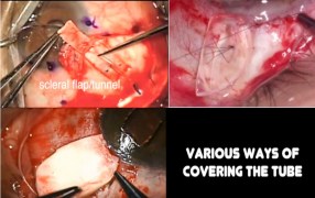 Amniotic Membrane as a Surgical Glaucoma Patch Allograft