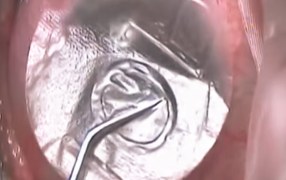 AmbioDisk in-office procedure - MD