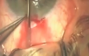 Atraumatic Conjunctival Dissection by Dr. Eytan Blumenthal