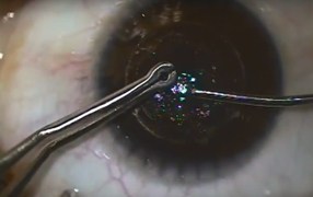 Basic SMILE Technique - Antonio Mendez, MD
