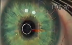 Dr. Chu displays LASIK Enhancement - Using Buratto Flap Forceps