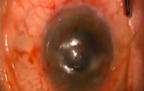 Ambio Graft Used in Corneal Ulcer Treatment