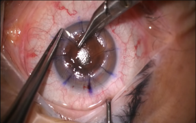 Corneal Tissue Addition For Keratoconus