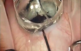 Arsham Sheybani, MD, Demonstrates Katena Surgical Gonio Prism