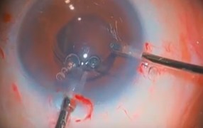 Donnenfeld IOL Removal System