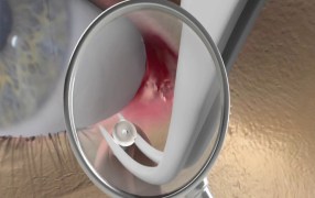 EagleVision Procedure Demo