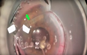 Arsham Sheybani, MD, Performs Goniosynechialysis