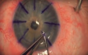 Dr. Holland, Demonstrates DALK Corneal Transplant