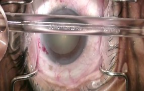 Combined Cataract & iStent Glaucoma Surgery