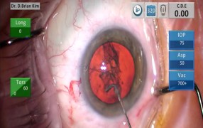Kim Capsular Fornix Hydrodissection Cannula from Katena Products