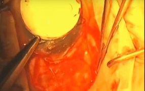 Pterygium Excision using Ambio2 and Cautery Fixation
