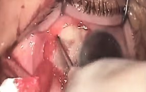 Pterygium Excision using Ambio5