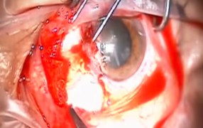 Pterygium Excision using Ambio5 and Mitomycin-C