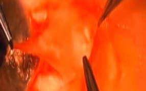 Pterygium Removal with Dehydrated Amniotic Membrane