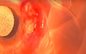 Pterygium Removal with Mitomycin-C