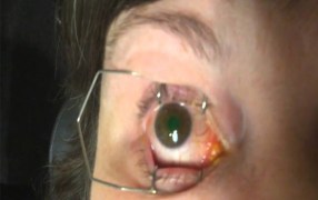 Recurrent Corneal Erosion Case Study Using AmbioDisk