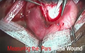 Sarkisian Scissor Used in the Implant of a Glaucoma Drainage Device