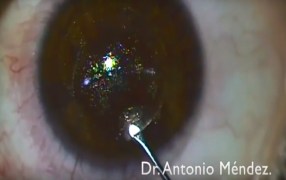 SMILE (Small Incision Lenticular Extraction) Procedure