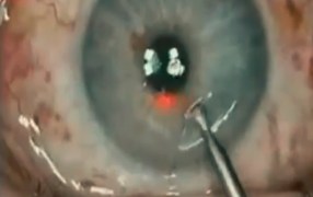 Thorlakson Z-LASIK Flap Lifter