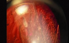 Arsham Sheybani, MD, Performs YAG Capsulotomy